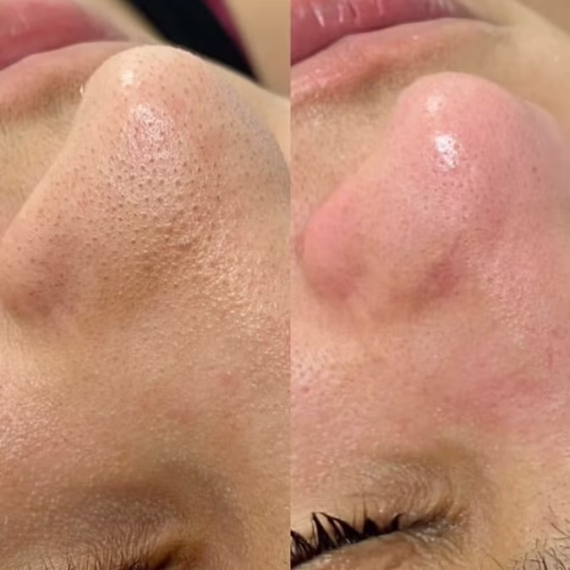 Hydrofacial 5 star glow
